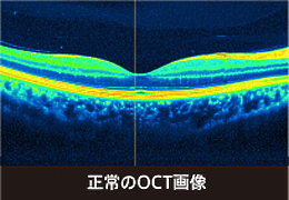 正常のOCT画像