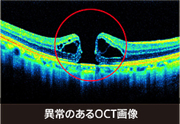 異常のあるOCT画像